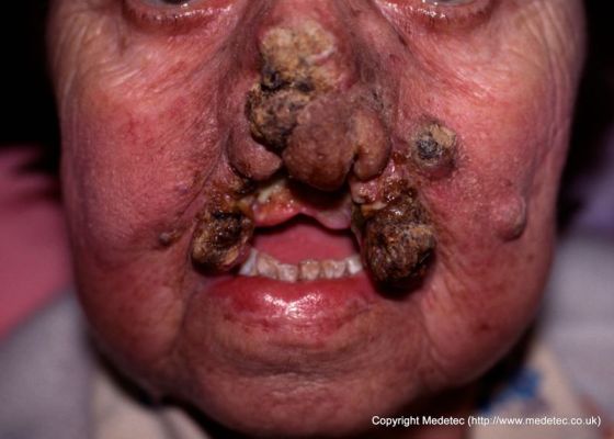 Large fungating malignant wound on face involving nose and lip